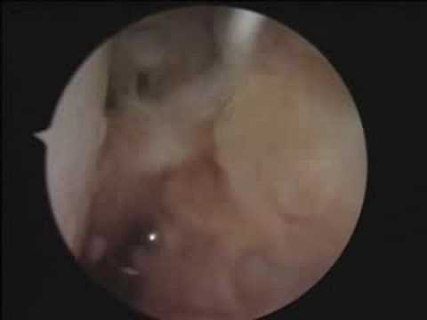 Elbow Capsule Incision In Rheumatoid Arthitis