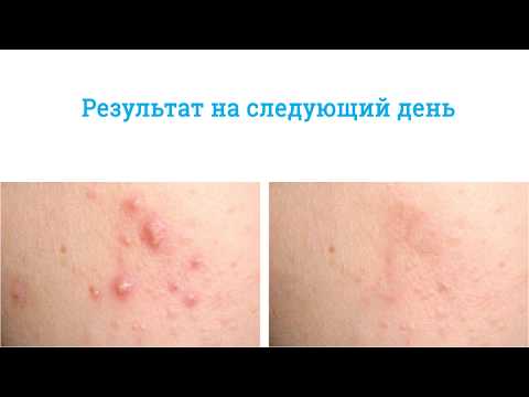 Отбеливающий крем для жирный кожи Чем отличается пигментное пятно от