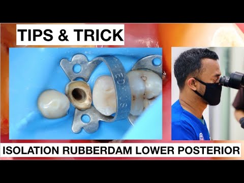 Tips and Trick Isolation With Rubberdam Lower Premolar With Double Clamp