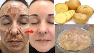 Potato to treat skin pigmentation, dark spots, acne scars | Anti-aging treatment to get clear skin