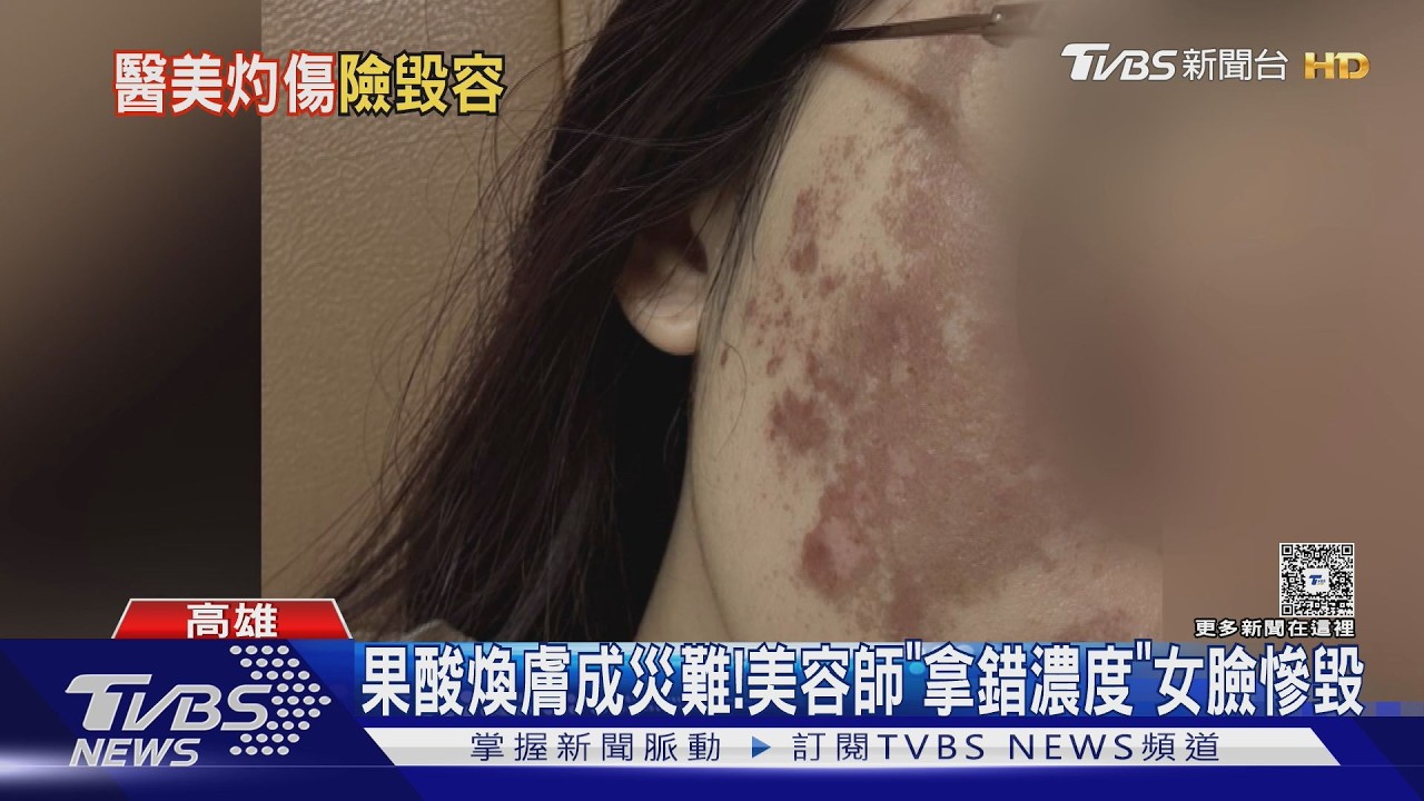 影音/果酸煥膚變災難! 濃度「40%變70%」女子臉嚴重灼傷