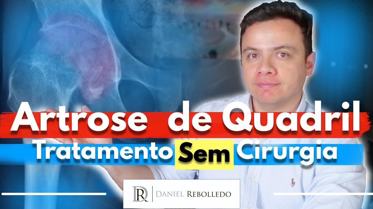 Artrose no Quadril. 9 Dicas de Tratamento Sem Cirurgia