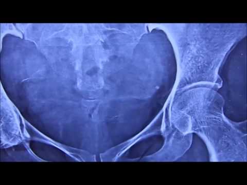 Radio Opaque Shadow near Pelvic Brim