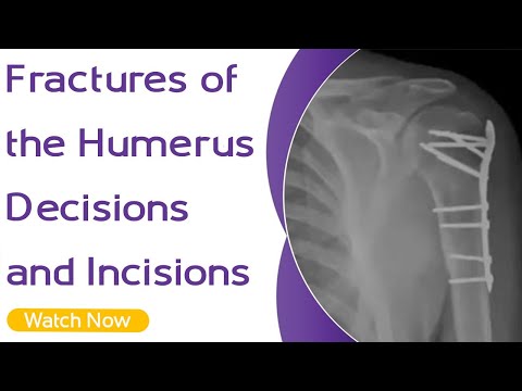 Fractures of the Humerus