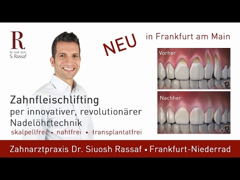 Zahnfleischrückgang: Neue innovative Behandlung durch sanftes Verschieben des Zahnfleischs