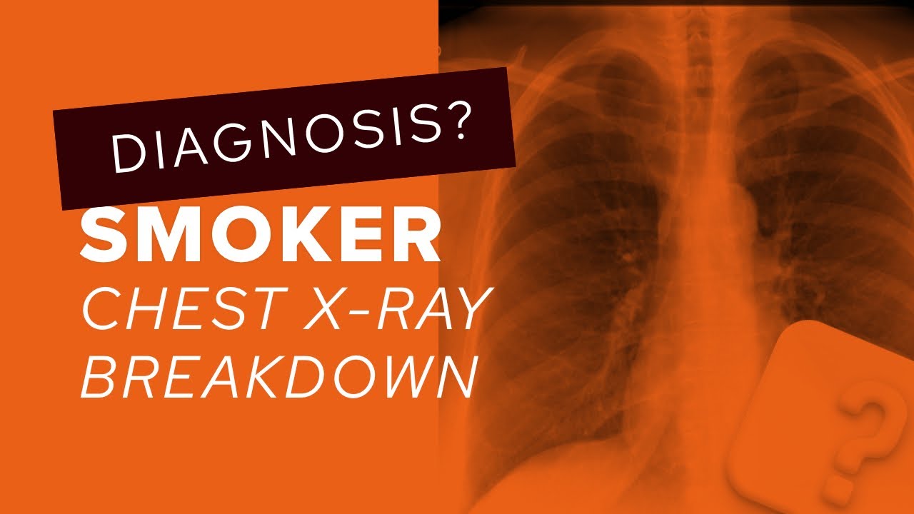 Chest X-Ray breakdown: how to assess for lung nodules