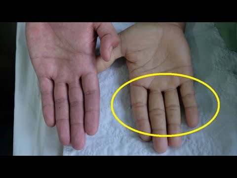 8 objawów anemii, które bagatelizujesz! |Zdrowie 24h