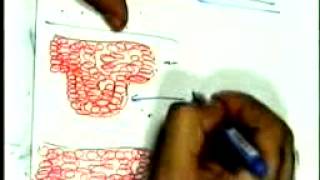 urinary bilharziasis 1  DR / SAMEH GHAZY