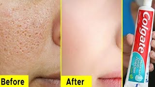 Top 3 Skin Whitening Colgate Home Toothpaste Treatments Lifestyle Tips || Traditional Beauty Tips