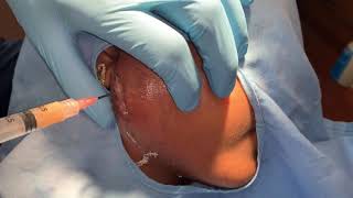 Drainage without Incision of a Post surgical Saliva collection - I &amp; D Surgery Video