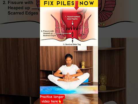 Fix Piles & Fissures Now🔥 #pilesrelief #fissure