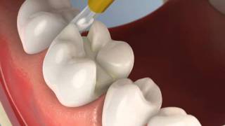 İnley Restorasyon Uygulama