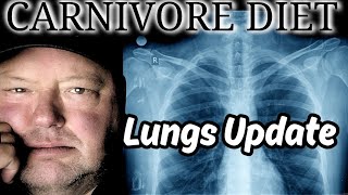 Lung Doctor Addresses My Cancer Fears..Here's What Happened