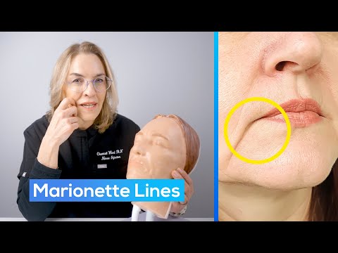 The Truth About Marionette Lines: Best Treatment Options