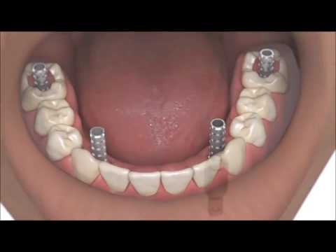 Dental Implants Coventry Dentists Show Best Same Day Full Whole Mouth Dental Teeth Implants Verum UK