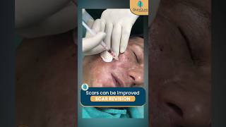 Scars Treatment with Punch Excision @SkinQure | #shorts #scarstreatment