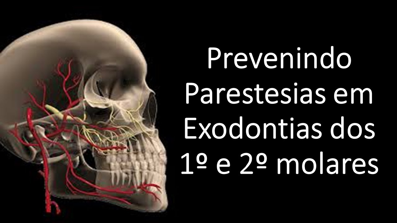 Prevenindo Parestesias em Exodontias dos 1º e 2º molares | Odontologia | Dra Bianca Rosa