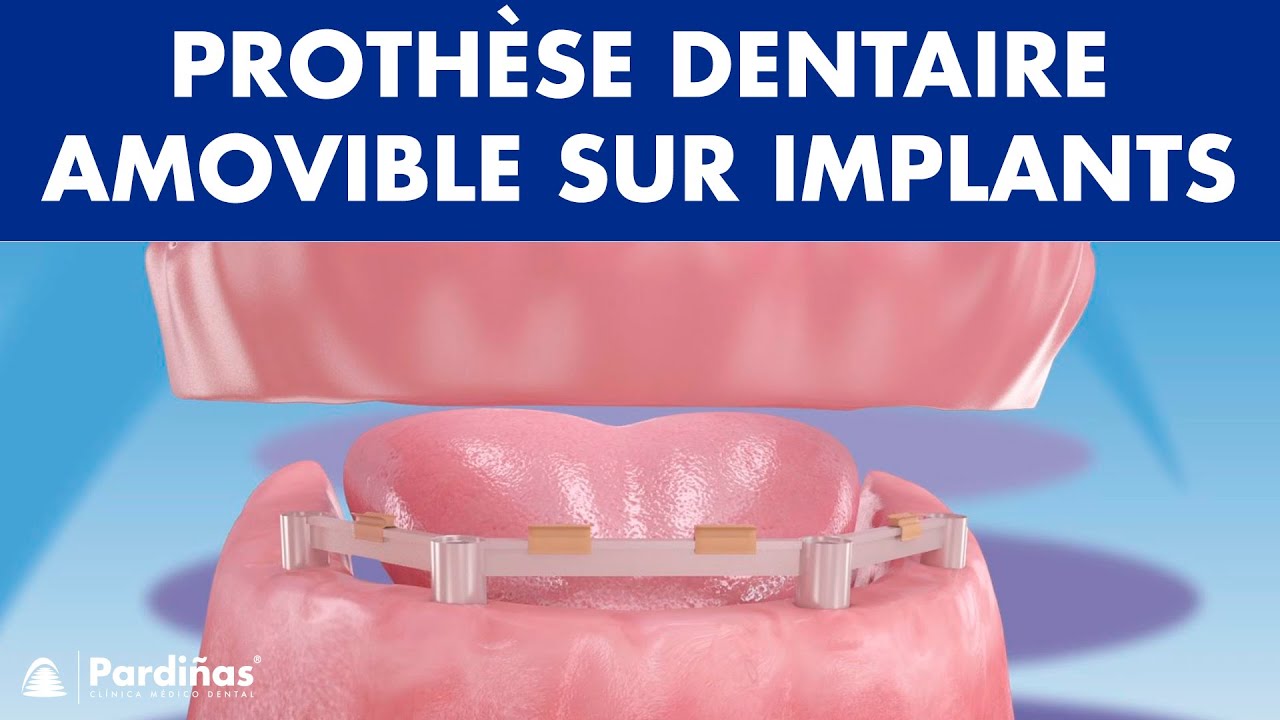 Prothèse dentaire amovible sur implants ©