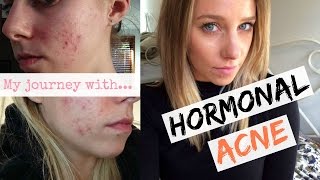 Hormonal Acne + The Pill: Curing My Hormonal Acne Naturally