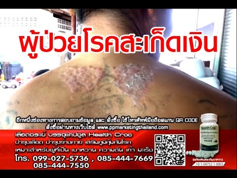 โรคสะเก็ดเงินเป็นบนเส้นผม ยาสำหรับเท้ากลาก