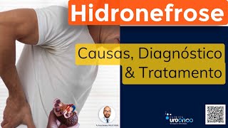 Hidronefrose (Rim Dilatado) | Como diagnosticar e tratar