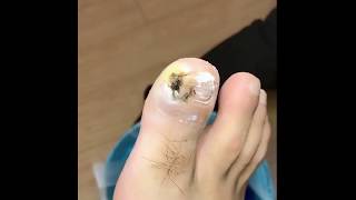 Paronychia, mild paronychia and polyp removal, intarsia burst out