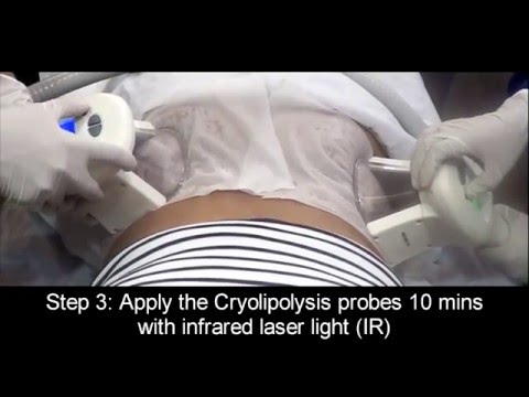 Cryolipolysis Treatment in Mumbai, India