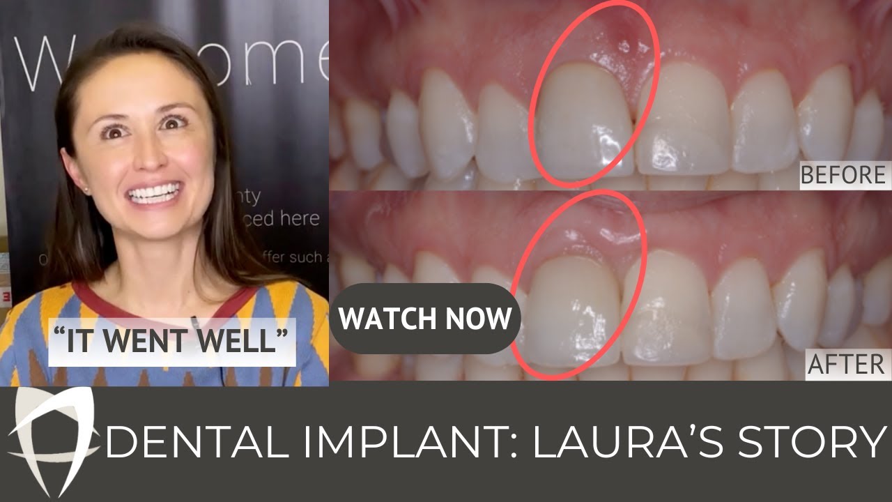 Laura - Single Implant (UR1) - Immediate Placement & Loading