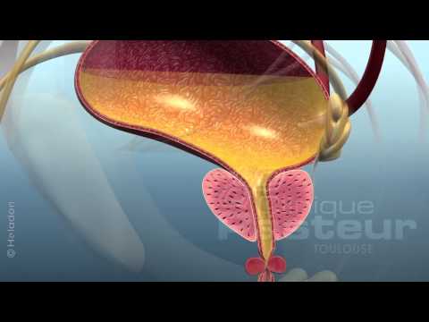 Urology - Prostate adenoma - Medical treatment