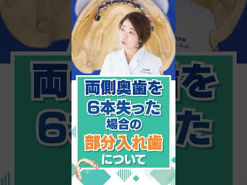 両側奥歯を6本失った場合の患者様の治療例について