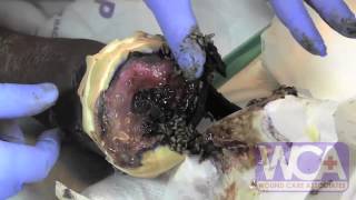 Maggot Therapy for Wounds - Wound Medicine Medcentris