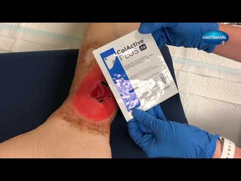 Application of ColActive Plus with Proximel