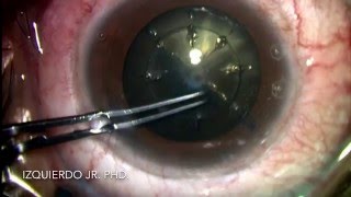 Laser assisted cataract surgery (LACS) of a black cataract by Luis Izquierdo Jr., MD