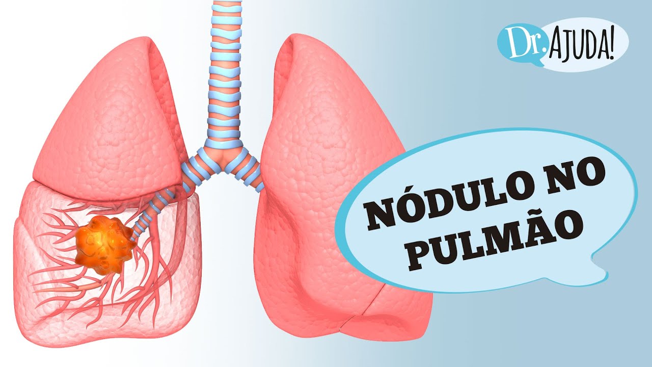 NÓDULO NO PULMÃO: COMO SABER SE É CÂNCER?