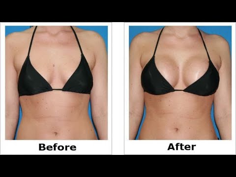 Surgery Modern Breast Enlargement in Bhopal