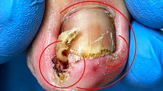 Ingrown Nails Are Inflamed, Be Careful To Cut Off The Sharp Corners【Xue Yidao】