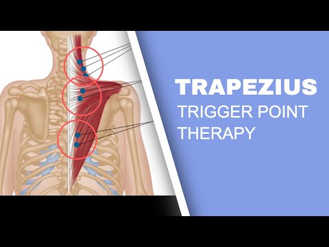 Trapezius Trigger Points and Headaches