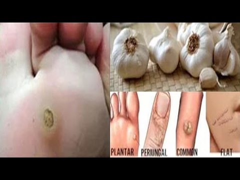 สมาชิกเพิ่มขึ้นในการใช้เครื่องมือ วิธีการที่ไม่ไส้เลื่อนขาหนีบ-scrotal ในความแรง