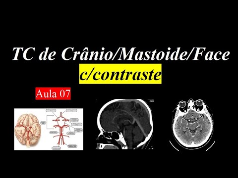 Curso de Tomografia c/contraste - Aula 7 (Crânio/Mastoide/Face)