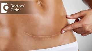 How to manage incision pain right after 1 month of Cesarean Section? - Dr. Shailaja N