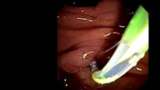 Large bile duct stone removal case study, D. Adler MD