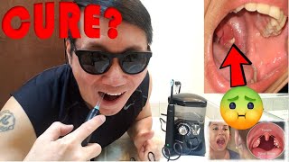How To Remove Tonsil Stones With A Water Flosser I Cure For Bad Breath