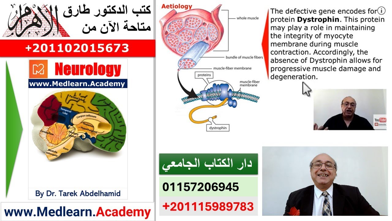 Duchenne muscular dystrophy (DMD) [1]
