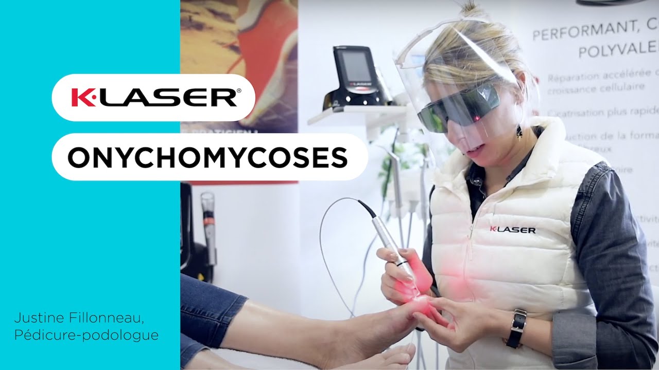Traitement indolore de l’onychomycose au K-LASER - formation PODOLOGIE