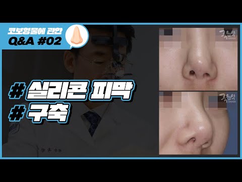 실리콘 보형물에 관한 Q&A #02 ｜#코성형부작용 #구축 #실리콘피막｜코성형 부작용