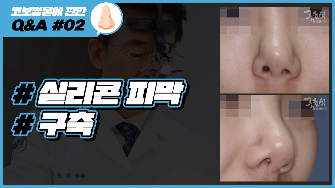 실리콘 보형물에 관한 Q&A #02 ｜#코성형부작용 #구축 #실리콘피막｜코성형 부작용 썸네일