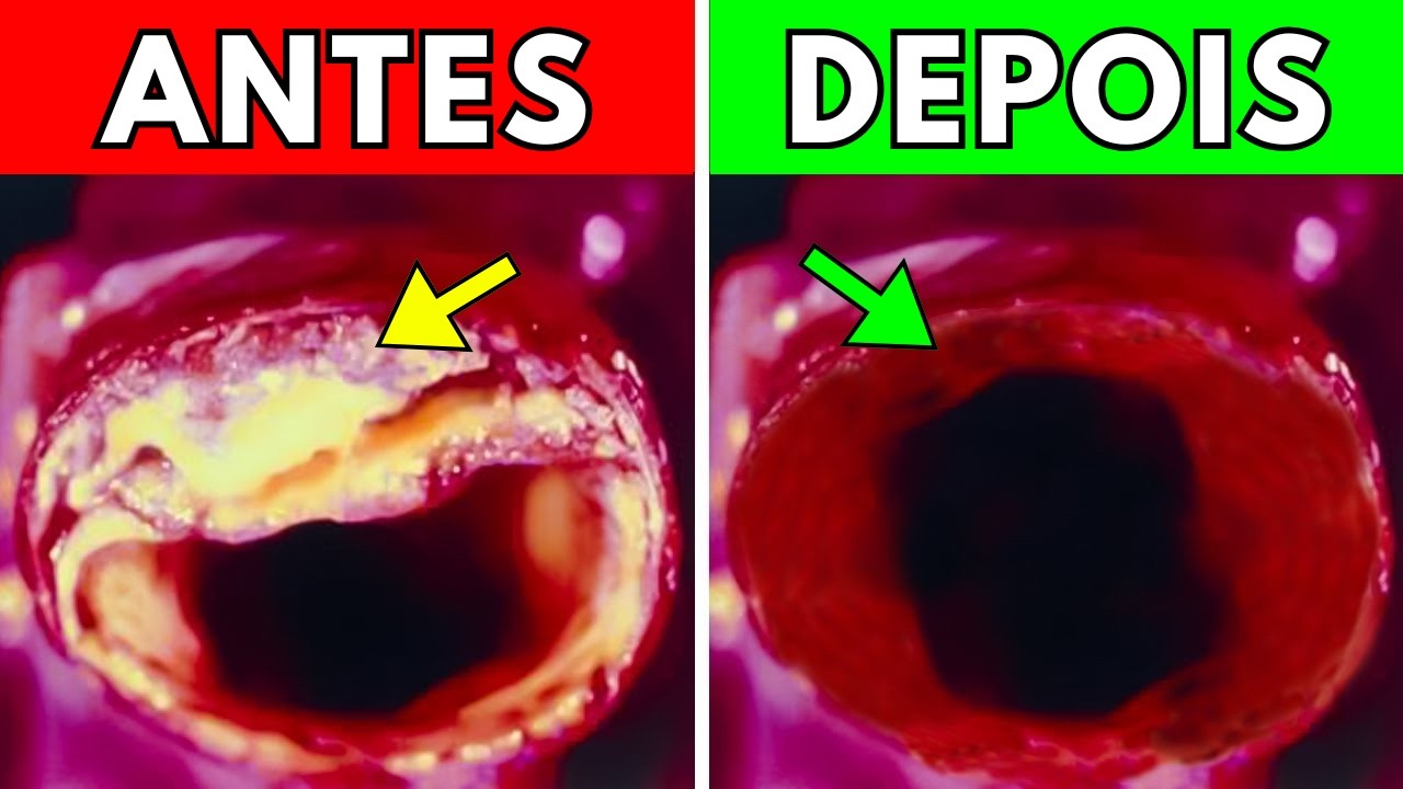 7 alimentos que LIMPAM suas artérias e previnem ataques cardíacos (INFARTO)