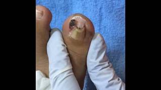 Ep_8923 Ingrown toenail removal 👣 มันเกิดจากที่พี่ทำแผลผิดวิธี 😅 (clip from Thailand)
