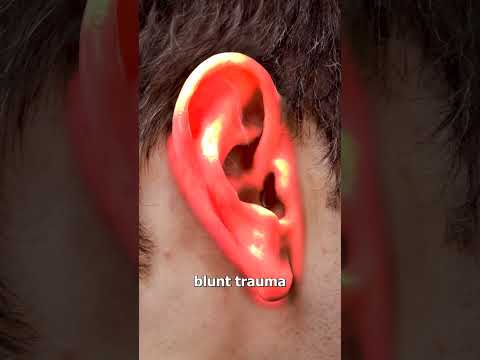 Why Athletes Get Cauliflower Ear 😬 (yikes)