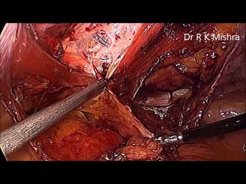 Clase magistral de reparación laparoscópica de hernia incisional